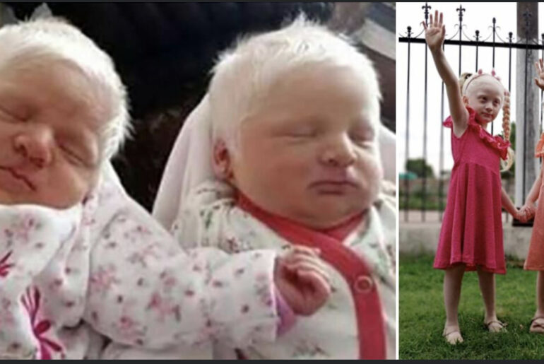 Mom gives birth to rare albino twins with snow-white hair