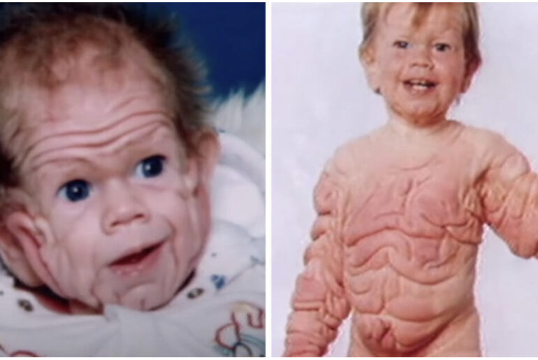 For reasons no one could figure out, this unique boy was born with more skin than a 5-year-old child