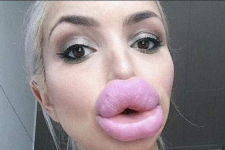13 people who most likely regret having their lips done