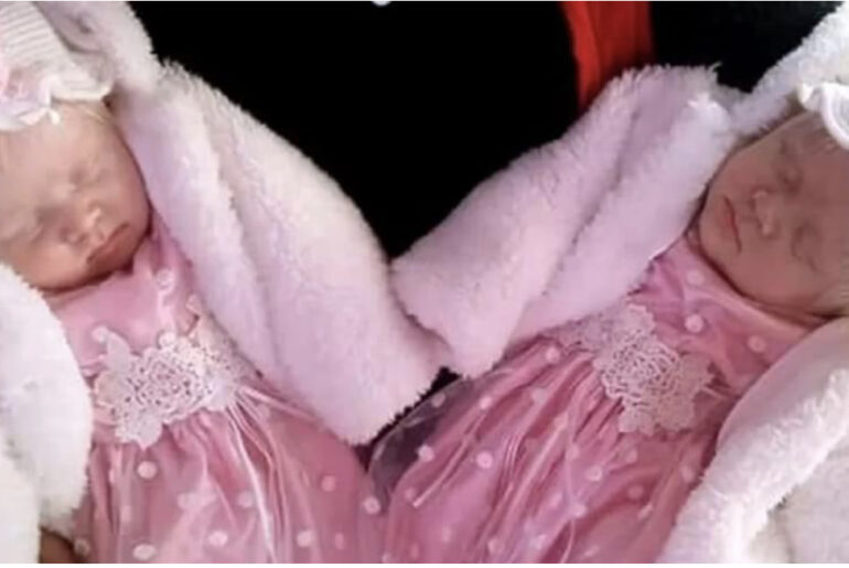 Mom delivers twin girls with matching snow-white hair, and their unique beauty comes out years later