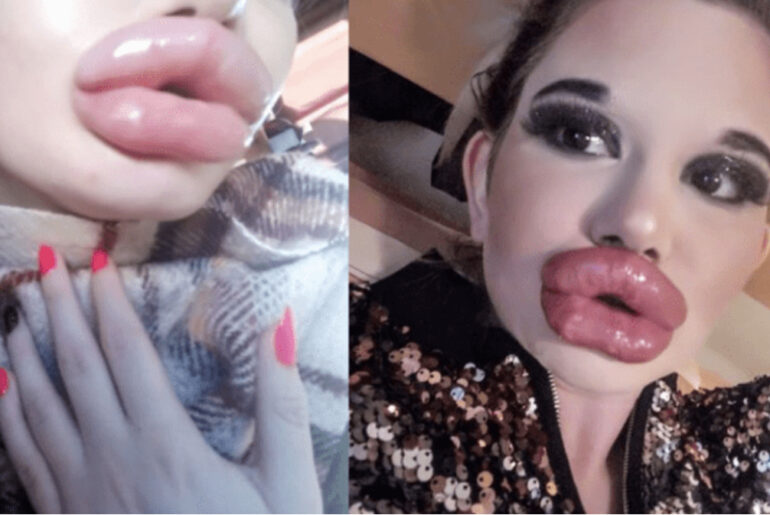“Real life barbie” gets her 20th lip filler injection to achieve the world’s fullest pout