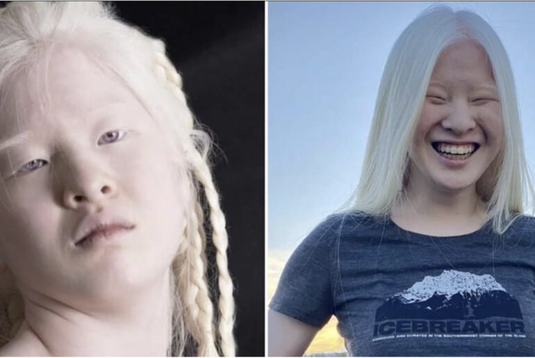 Girl abandoned by parents for her looks wants to prove the world wrong – now she models for Vogue