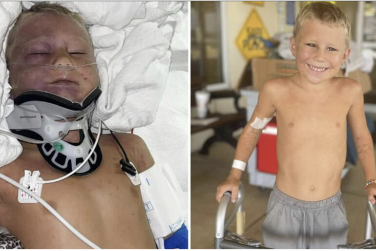 6-year-old boy severely injured after being run over by 18,000lb bulldozer – starts walking just few days later