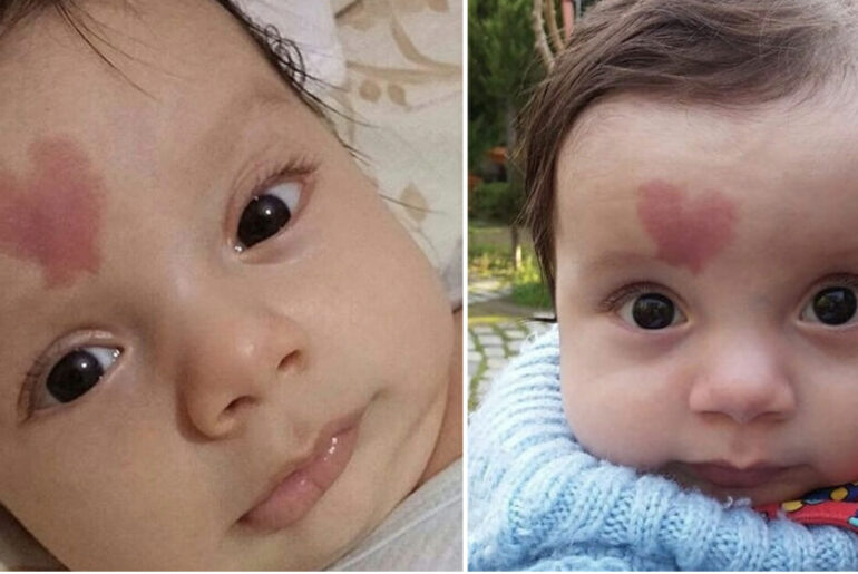 Baby born with ‘heart’ birthmark became world famous in 2015 – here’s what he looks like 7 years later