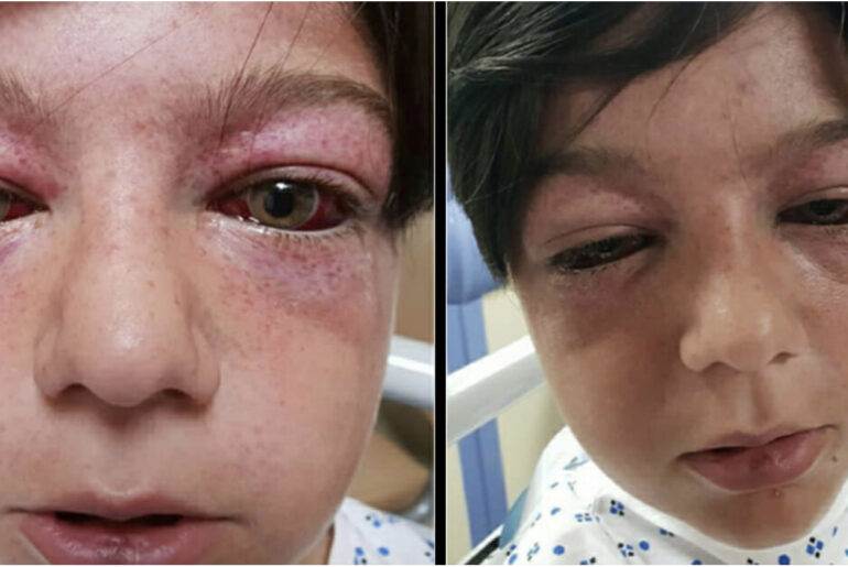 Playground craze leaves 11-year-old boy “looking like an alien” – mom has a warning for all parents