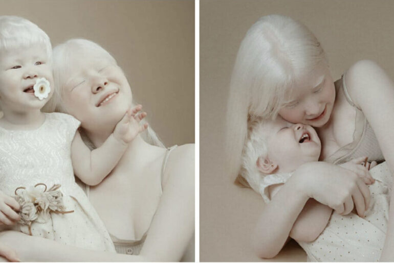 Albino sisters born 12 years apart become modeling sensations