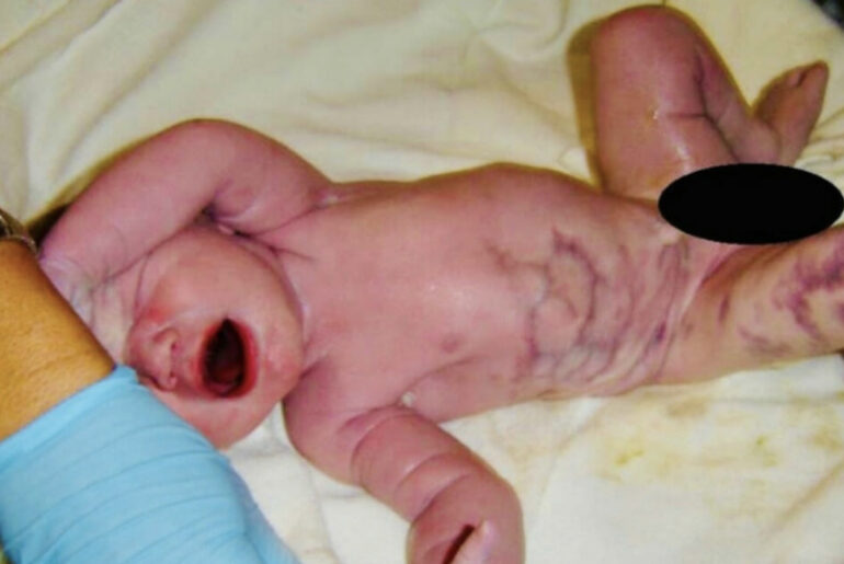 Mom delivers baby, forbidden from holding him when dad utters: “There’s something wrong with Adam’s leg”