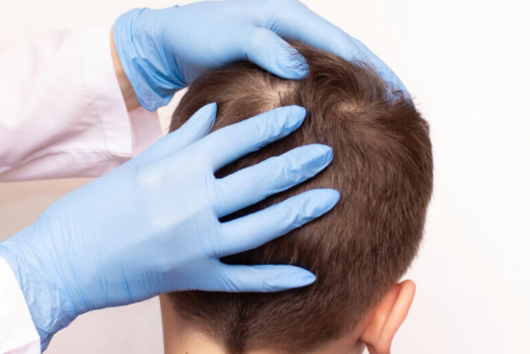 Man goes viral for extreme head lice infestation