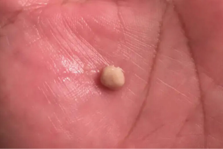Here’s what you need to know about tonsil stones – the weird pimple-like growths in your throat