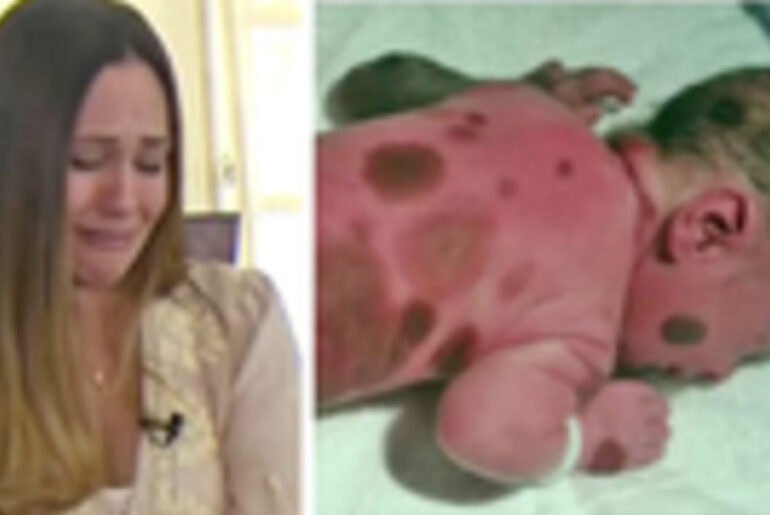 Mom doesn’t dare go outside with baby born with black spots