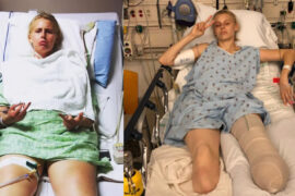 Her legs are amputated after using a common household product